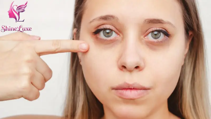 تیرگی دور چشم چیست و چرا ایجاد میشود؟